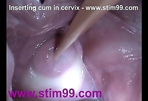 Intercalate semen cum prevalent cervix respecting dilation snatch reflector